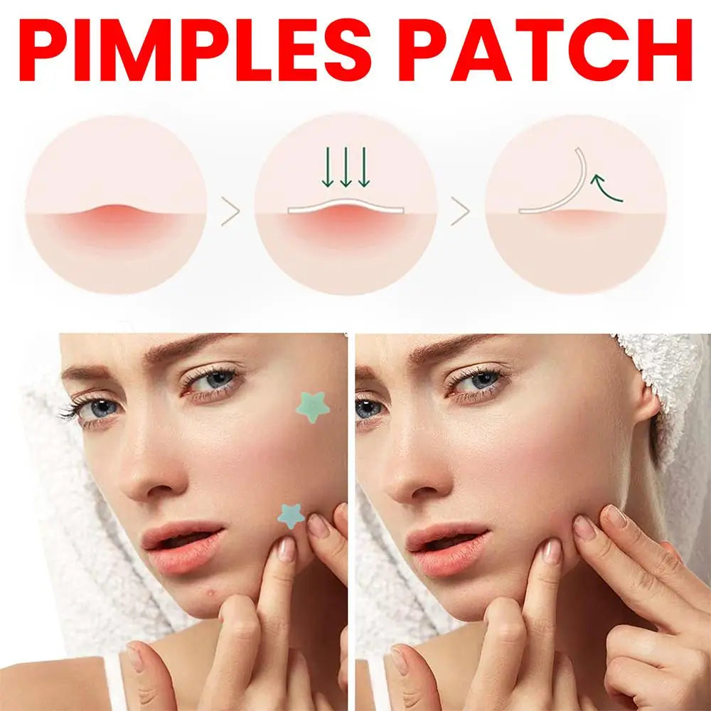 200Pcs Star Pimple Patch Acne Invisible Removal Stickers