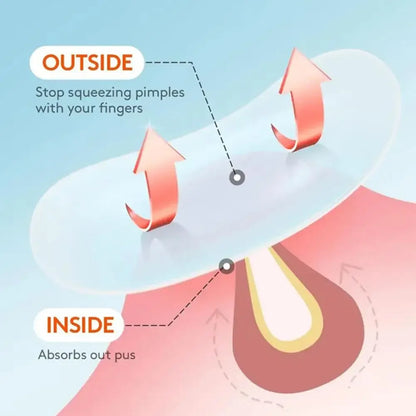 Hydrocolloid Acne Patches for Pimples & Blemishes