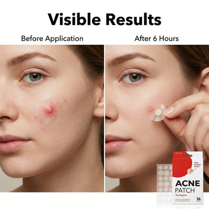 Hydrocolloid Acne Pimple Patch